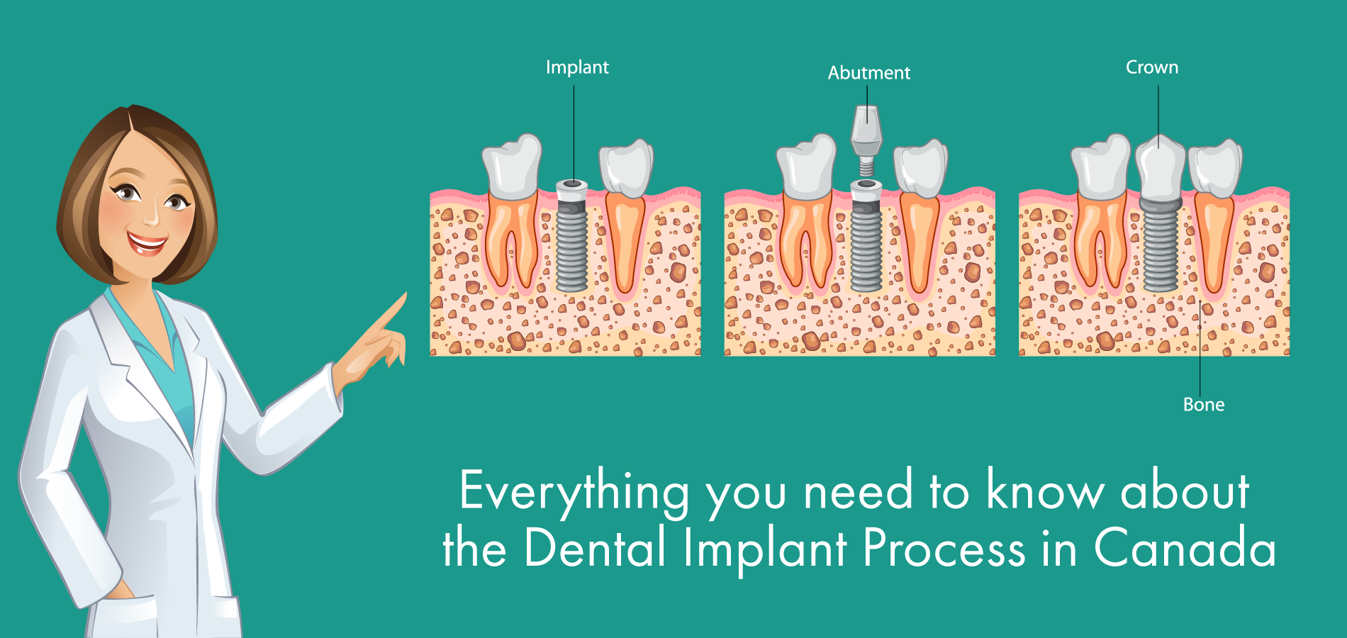 Everything you need to know about the Dental Implant Process in Canada